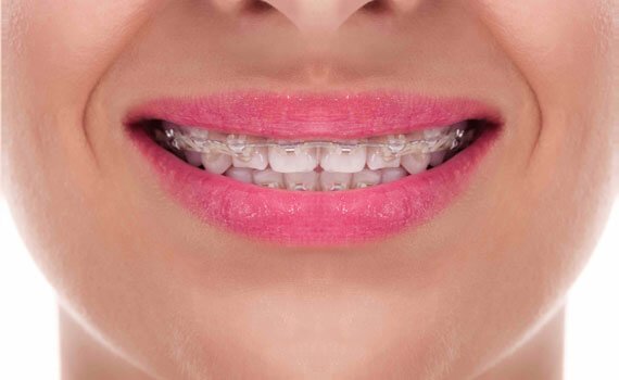 How much will my Invisalign clear aligners cost in Kerala?, by Teethos  Dental