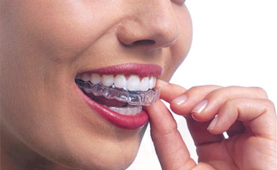 How much will my Invisalign clear aligners cost in Kerala?, by Teethos  Dental